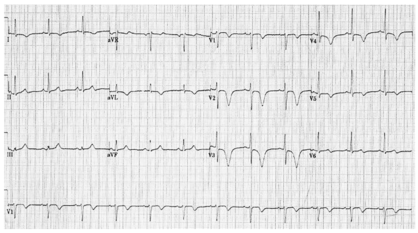 Eletrocardiograma de 12 derivações com calibração padrão, dispostas em três linhas (I, aVR, V1, V4; II, aVL, V2, V5; III, aVF, V3, V6) e um traçado longo de V1 na parte inferior, sobre papel quadriculado. Nas derivações V2, V3 e V4 aparecem ondas T negativas profundas.