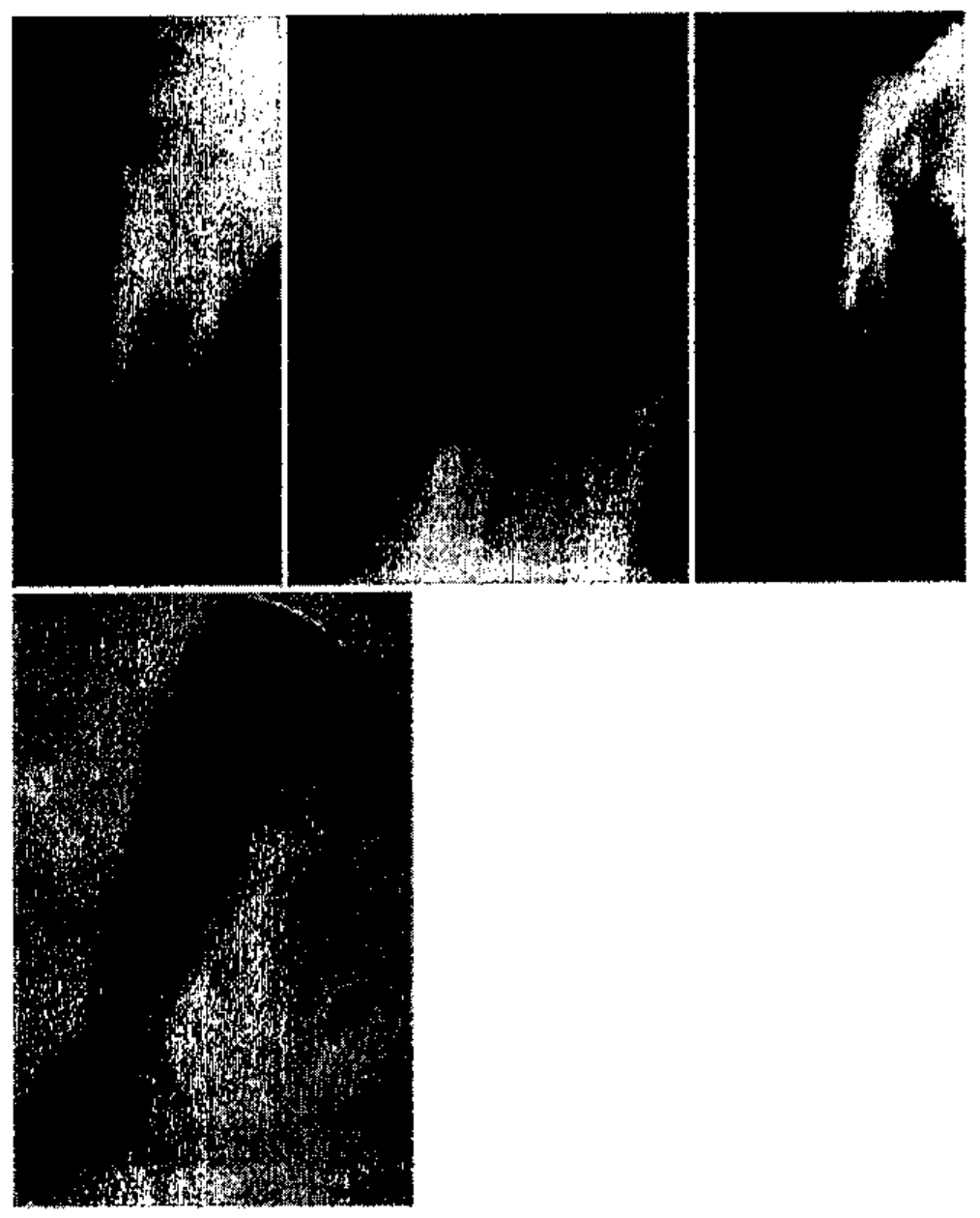 Painel com quatro imagens radiográficas digitalizadas em baixa qualidade (três quadros na linha superior e um na inferior), em tons de cinza com granulação intensa, mostrando segmentos ósseos.