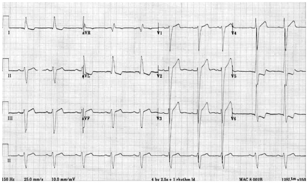 Eletrocardiograma de 12 derivações em papel milimetrado (derivações I, II, III, aVR, aVL, aVF, V1 a V6 e tira de ritmo em DII), com a inscrição de rodapé “150 Hz 25,0 mm/s 10,0 mm/mV”.
