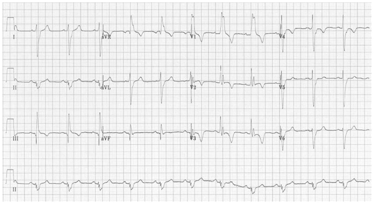 Eletrocardiograma de 12 derivações em papel milimetrado (derivações I, II, III, aVR, aVL, aVF, V1 a V6 e tira de ritmo em DII), com calibração padrão.