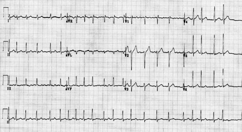 Eletrocardiograma de 12 derivações (I, II, III, aVR, aVL, aVF, V1 a V6) com tira de ritmo em DII ao final, registrado na chegada da paciente do caso clínico 10A1-II ao pronto-socorro.