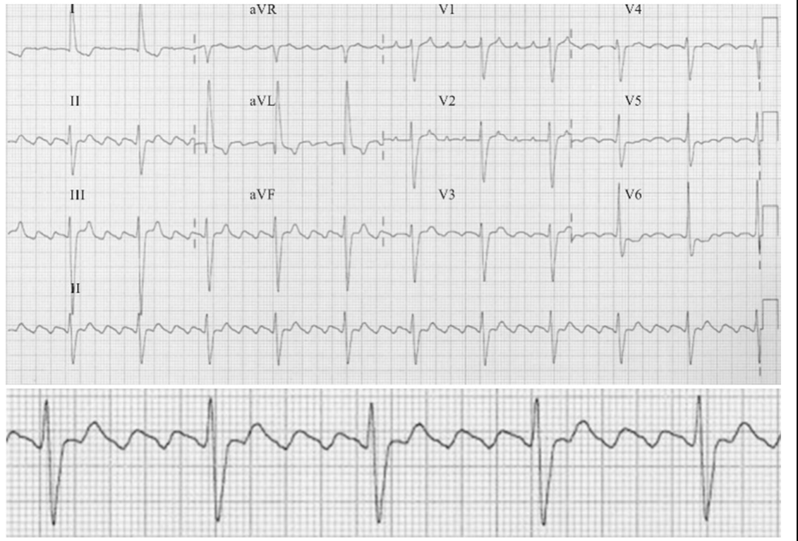 Eletrocardiograma de 12 derivações, em quatro linhas (I, aVR, V1, V4; II, aVL, V2, V5; III, aVF, V3, V6; e tira longa de DII), seguido de traçado ampliado da derivação DII, em papel quadriculado.