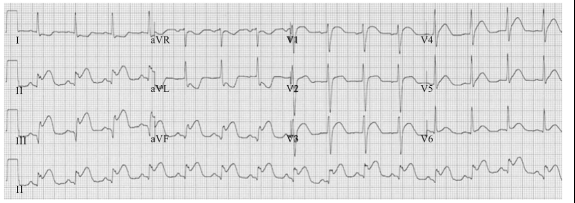 Eletrocardiograma de 12 derivações, em quatro linhas (I, aVR, V1, V4; II, aVL, V2, V5; III, aVF, V3, V6; e tira longa de DII), em papel quadriculado.