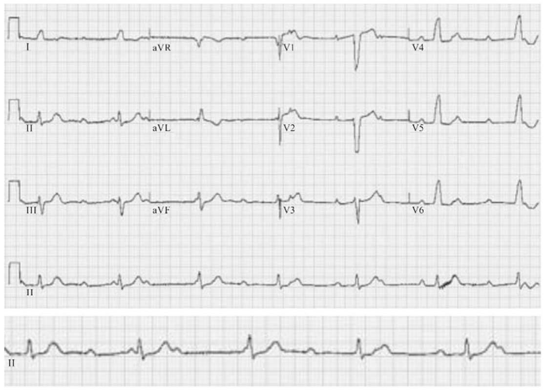 Eletrocardiograma de 12 derivações, em quatro linhas (I, aVR, V1, V4; II, aVL, V2, V5; III, aVF, V3, V6; e tira longa de DII), seguido de traçado ampliado da derivação DII, em papel quadriculado.
