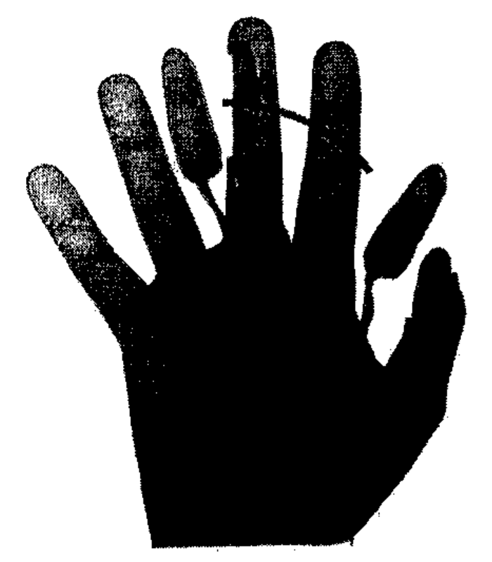 Desenho esquemático da face palmar de uma mão com um retalho em ilha pediculado no feixe neurovascular de um lado do dedo médio, transposto em direção ao polegar.