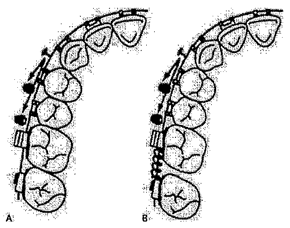 Duas ilustrações, A e B, de vista oclusal de uma hemiarcada superior com aparelho fixo e dispositivo de ancoragem temporária, mostrando dois métodos de distalização dos molares: em A, a dentição é distalizada em conjunto; em B, com mola espiral junto aos molares, os molares são movimentados distalmente primeiro.