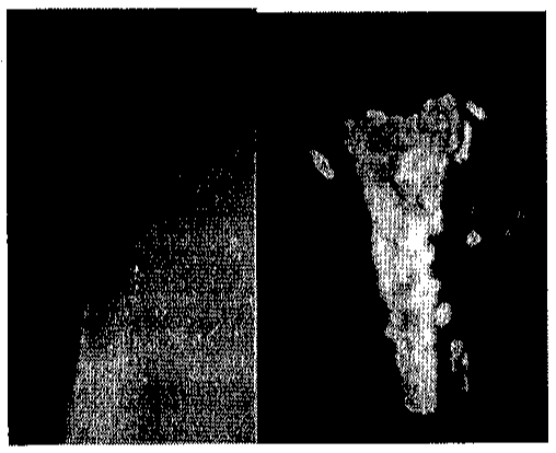 Duas imagens lado a lado do úmero proximal: à esquerda, radiografia; à direita, ressonância magnética com lesão de sinal heterogêneo e contorno lobulado na região proximal e metafisária do úmero.