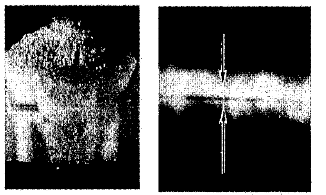 Duas fotografias lado a lado: à esquerda, macrografia da seção transversal de um cordão de solda; à direita, radiografia da face superior do mesmo cordão, com duas setas verticais opostas apontando para uma linha escura ao longo do cordão.