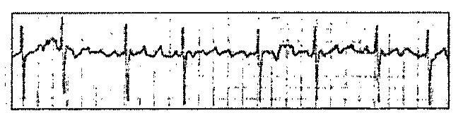 Traçado de eletrocardiograma (tira de ritmo de uma derivação) realizado na admissão do paciente descrito no enunciado.