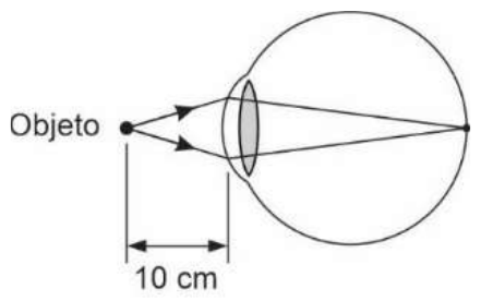 Olho com objeto a 10 cm; os raios convergem sobre a retina.
