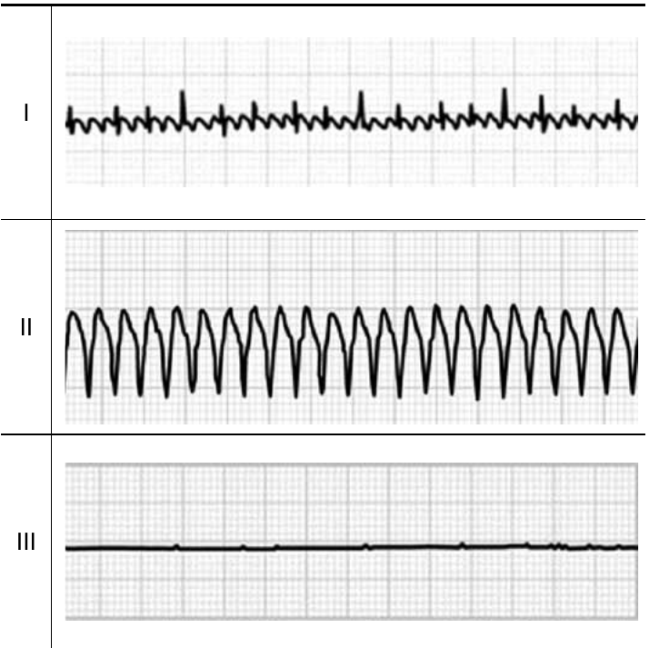 Três traçados eletrocardiográficos sobre papel quadriculado, identificados como I, II e III: I – sequência contínua de pequenas deflexões rápidas; II – ondas largas e de grande amplitude, rápidas e repetitivas; III – linha praticamente reta, com raras deflexões mínimas.