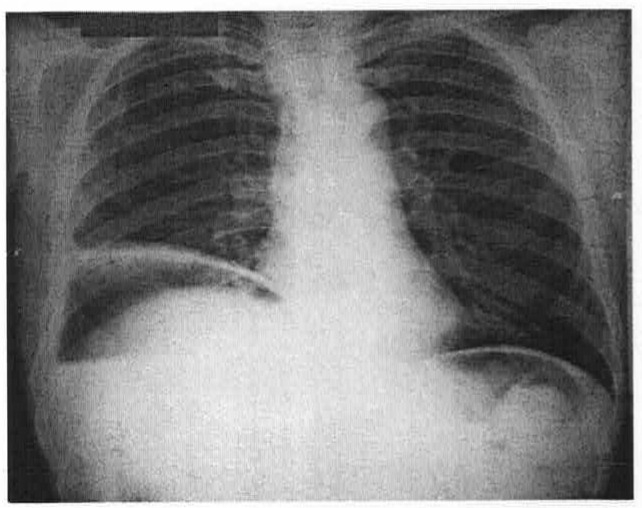 Radiografia simples em incidência frontal abrangendo tórax e abdome superior, com faixas de ar sob as duas cúpulas diafragmáticas.