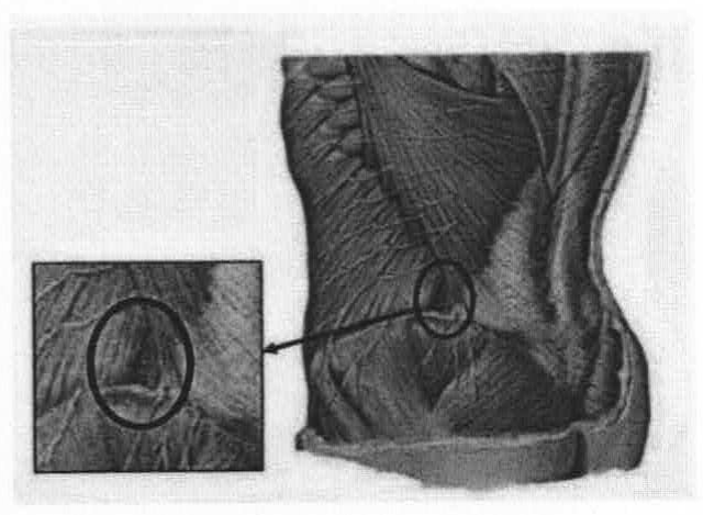 Ilustração anatômica da região lateral do tronco e flanco, com uma área circulada acima da crista ilíaca e, à esquerda, um detalhe ampliado da mesma área também circulado, ligado por uma seta.