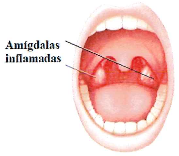 Ilustração de uma boca aberta com a indicação “Amígdalas inflamadas”.